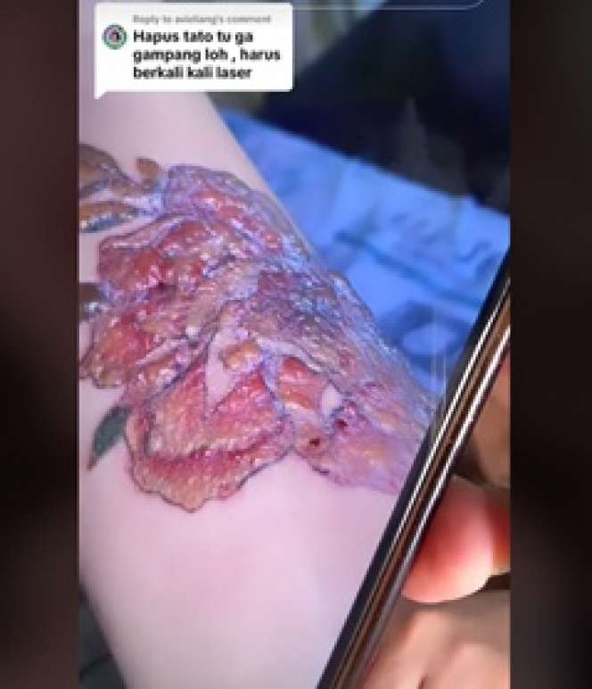 Perjuangan Nathalie Holscher Hapus Tato di Tubuhnya, Sakitnya Minta Ampun!