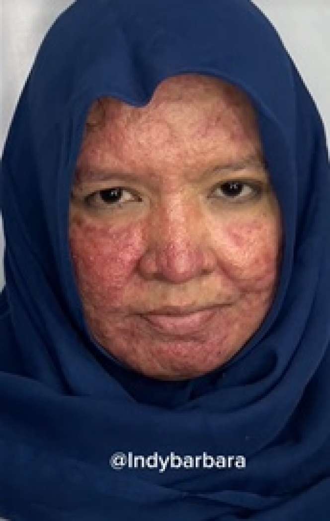 Wajah Beruntusan Parah, Pengantin Sunda Ini Bisa Tampil Memesona di Hari Pernikahan Berkat Tangan Ajaib MUA, Hasilnya Bikin Pangling!