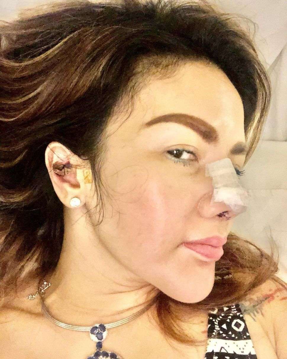 Pengen Mancung! Sederet Seleb Ini Lakukan Operasi Hidung, Harganya Bikin Kantong Menjerit