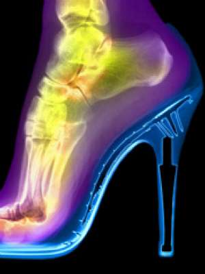 Kenali Bahaya Menggunakan High Heels Untuk Kesehatan