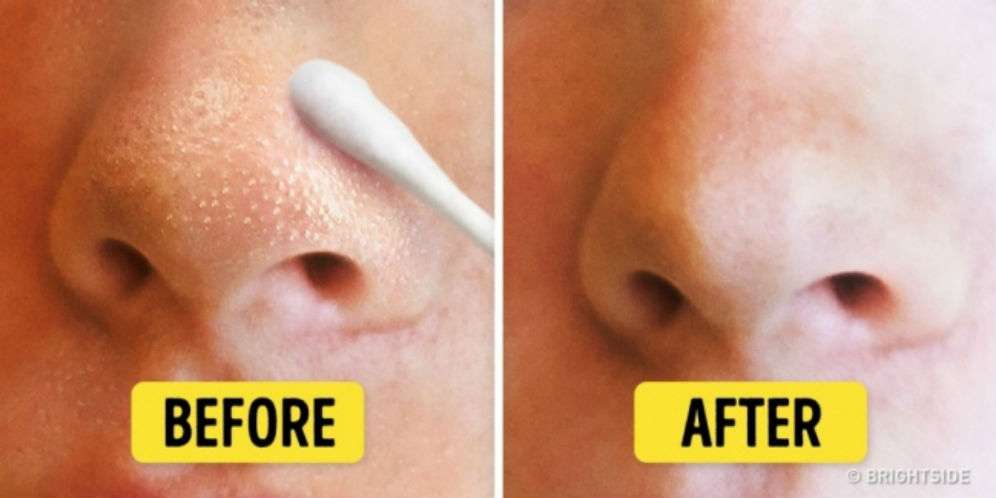 9 Cara Alami Singkirkan Komedo pada Wajah dan Hidung