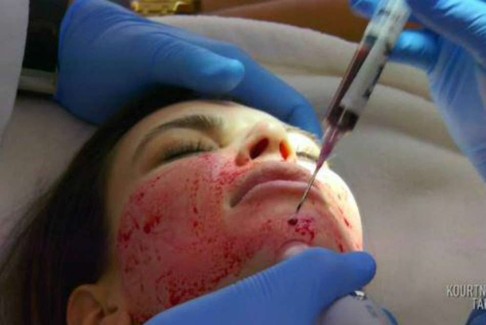 Viral! Perawatan Kecantikan Facial Vampir, Berani Coba?
