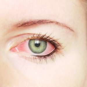 Hanya dengan Memandang Penderita, Sakit Mata Merah Menular?