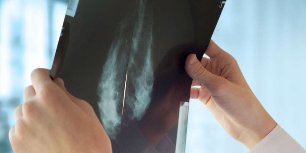 Masuki Usia 40, Jangan Lupa Periksa Mammografi