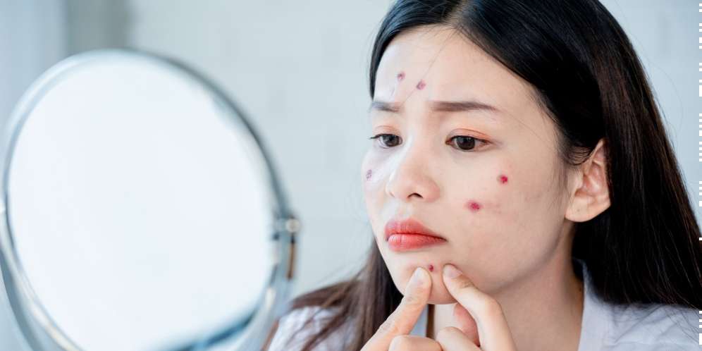 Tips Menghilangkan Bekas Jerawat