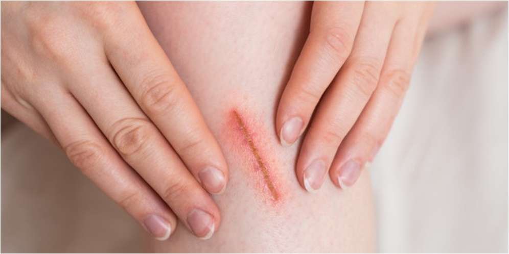 13 Rekomendasi Obat Pengering Luka dengan Cepat dan Efektif