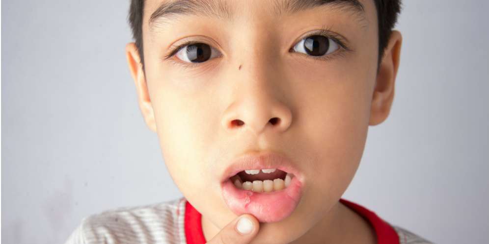Sariawan Pada Anak Bisa Jadi Parah, Kapan Harus ke Dokter?