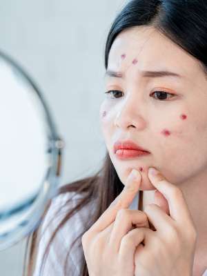4 Tips Menyamarkan dan Meredakan Jerawat Agar Wajah Mulus