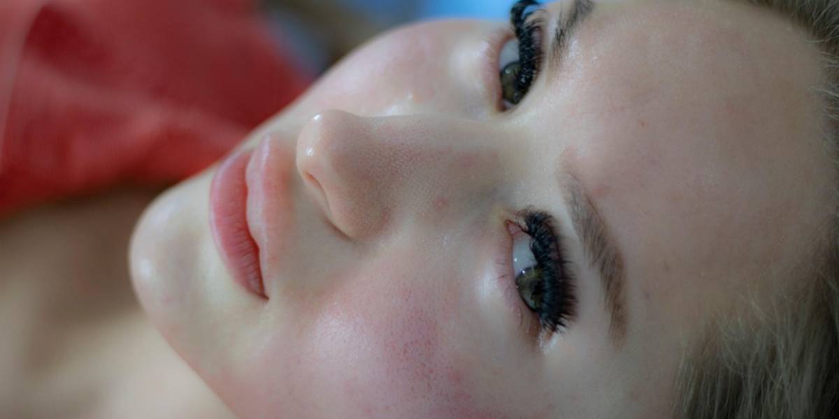 Gejala Hingga Penyebab Penyakit Kulit Rosacea